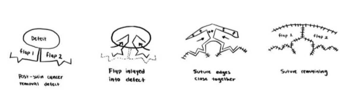 Reconstructive Schematic