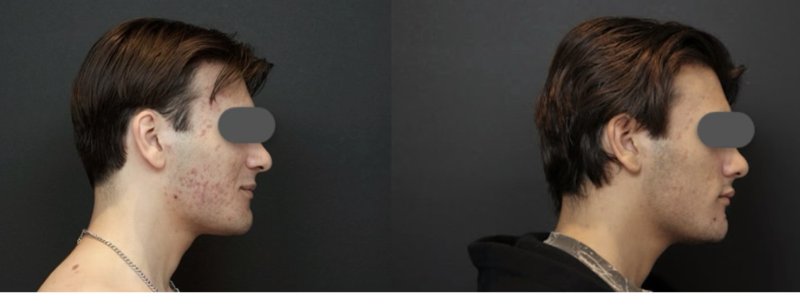 before after